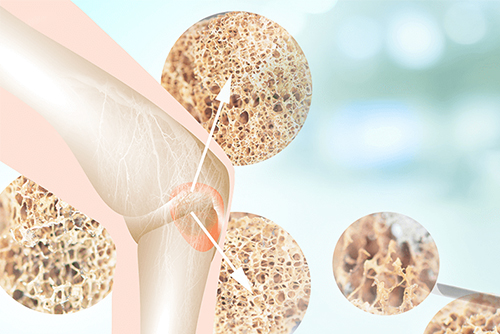 骨質疏鬆症