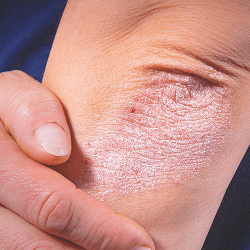 干癣是一种免疫系统失调的疾病,由于皮肤的免疫系统失调导致皮肤细胞